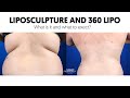 Liposculpture and 360 Lipo: What is it? | Before and After Photos