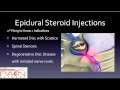 5 Things to Know About Epidural Steroid Injections (602) 507-6550