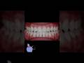 Профессиональное отбеливание зубов #shorts #стоматология #стоматолог #зубы