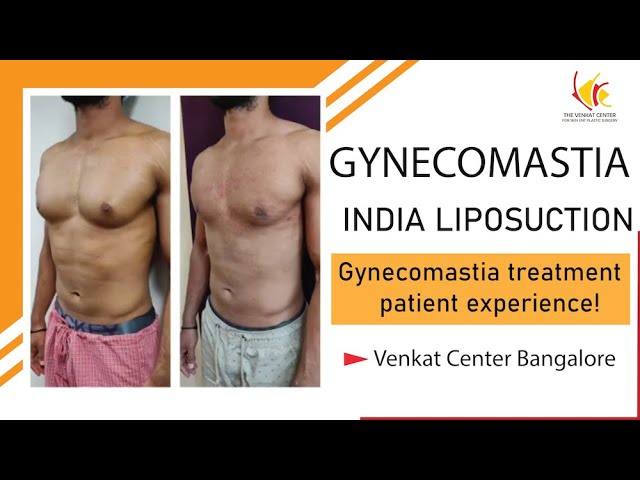 Gynecomastia treatment- a patient experience! Venkat Center