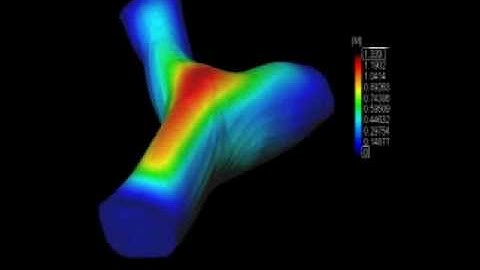 Blood flow of a carotid bifurcation, fluid-structure interactio