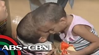 TV Patrol: Conjoined twins near operation