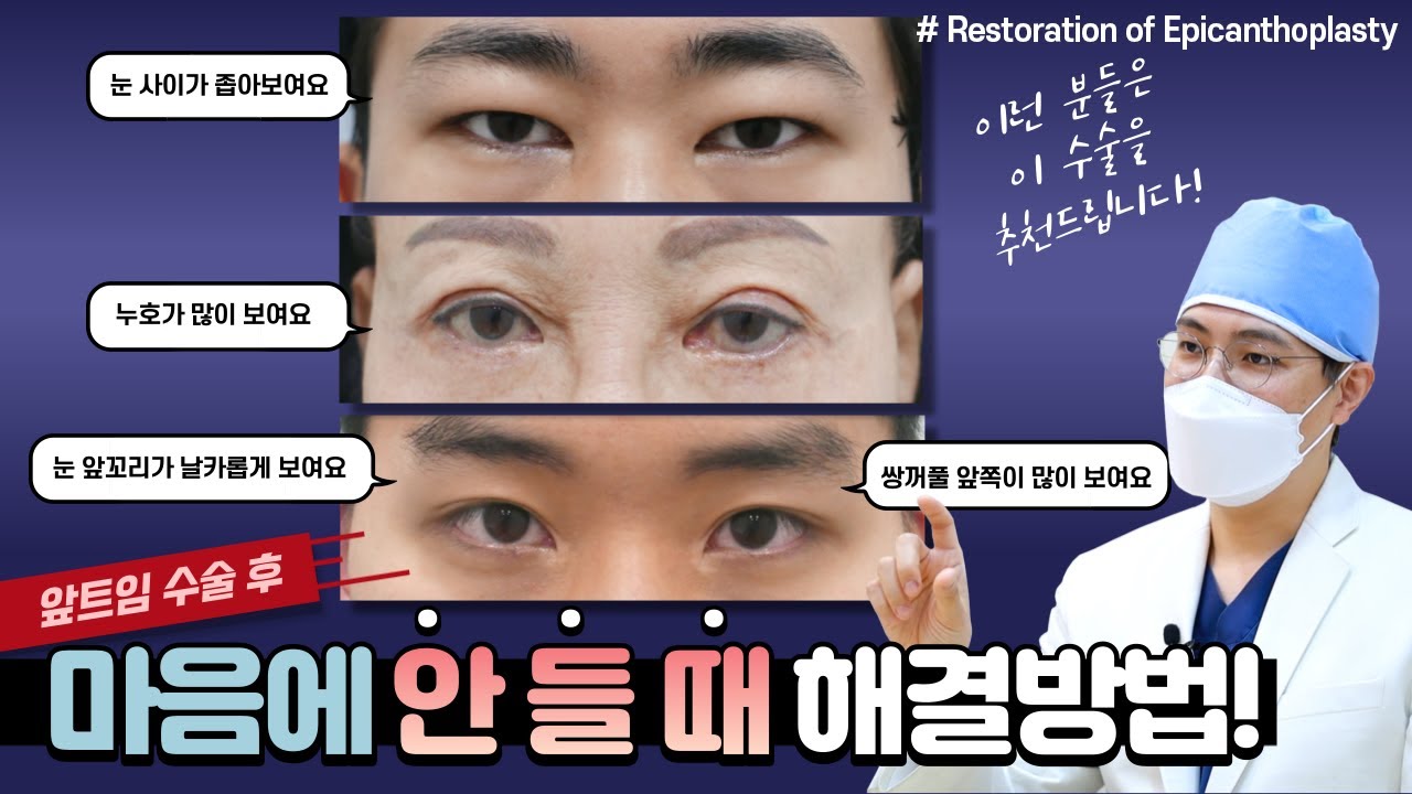 [Jayjun Phẫu thuật thẩm mỹ và Da liễu] Nếu bạn có đôi mắt như thế này, hãy lấy lại hình dạng mắt mong muốn bằng phẫu thuật phục hồi góc mắt trong~!!