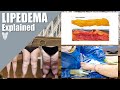 What is lipedema and how is lipedema treated  total lipedema care  dr jaime schwartz