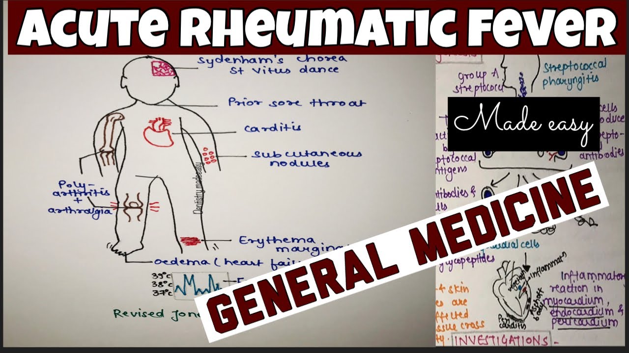 ACUTE RHEUMATIC FEVER || CARDIOVASCULAR SYSTEM || GENERAL MEDICINE || NEET SERIES || 3rd YEAR BDS