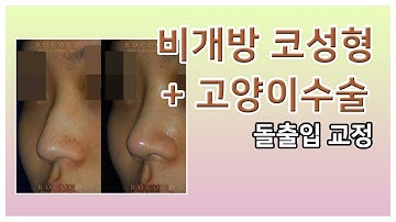로코코 비개방코성형   고양이수술(돌출입교정) feat.전후사진 (before and after /Rhinoplasty)