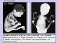 Lethal Congenital Contracture Syndromes LCCS; multiple joint contractures arthrogryposis