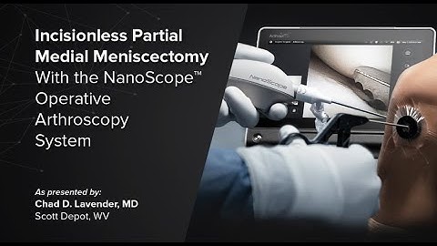 Incisionless Partial Medial Meniscectomy With the NanoScope™ Operative Arthroscopy System