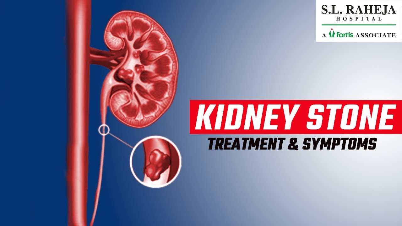 Kidney Stones Ka Ilaj Kidney Stones Symptoms & Treatment SLR YouTube