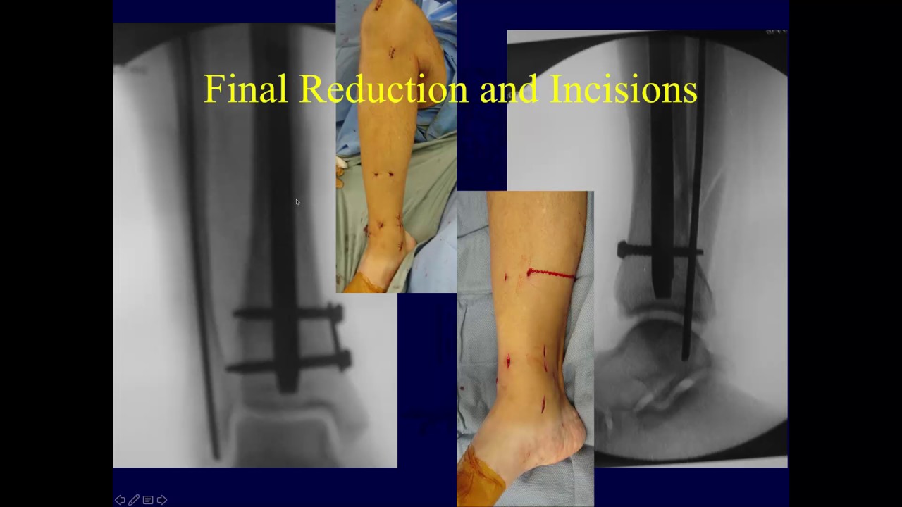 Retrograde tibial nailing of far distal tibia fractures: a biomechanical  evaluation of double- versus triple-distal interlocking | European Journal  of Trauma and Emergency Surgery