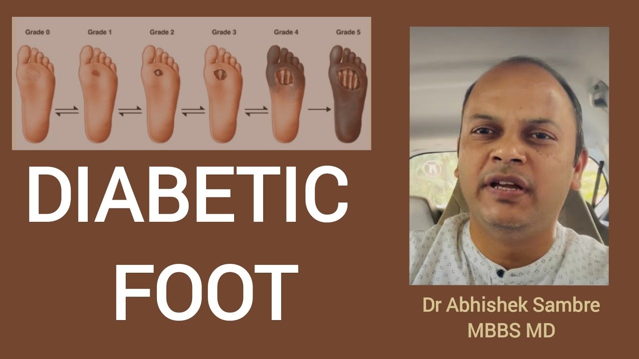 Diabetic Foot kya hai? prevention foot care tips YouTube