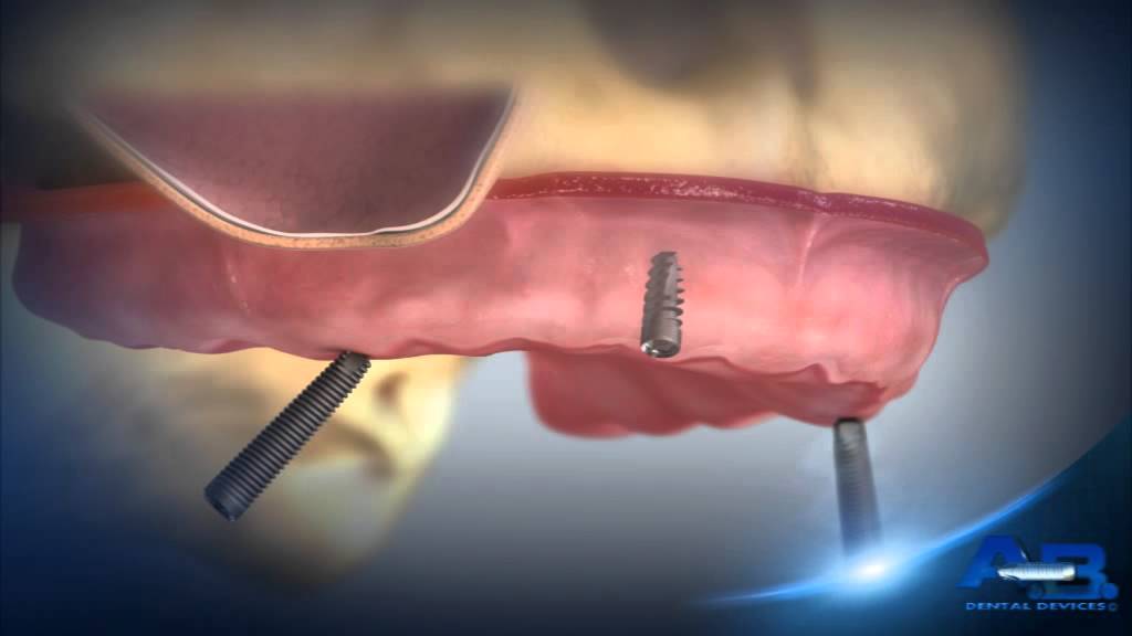 A B Implants Canada Extra long Implants for all on 4 rehabilitation