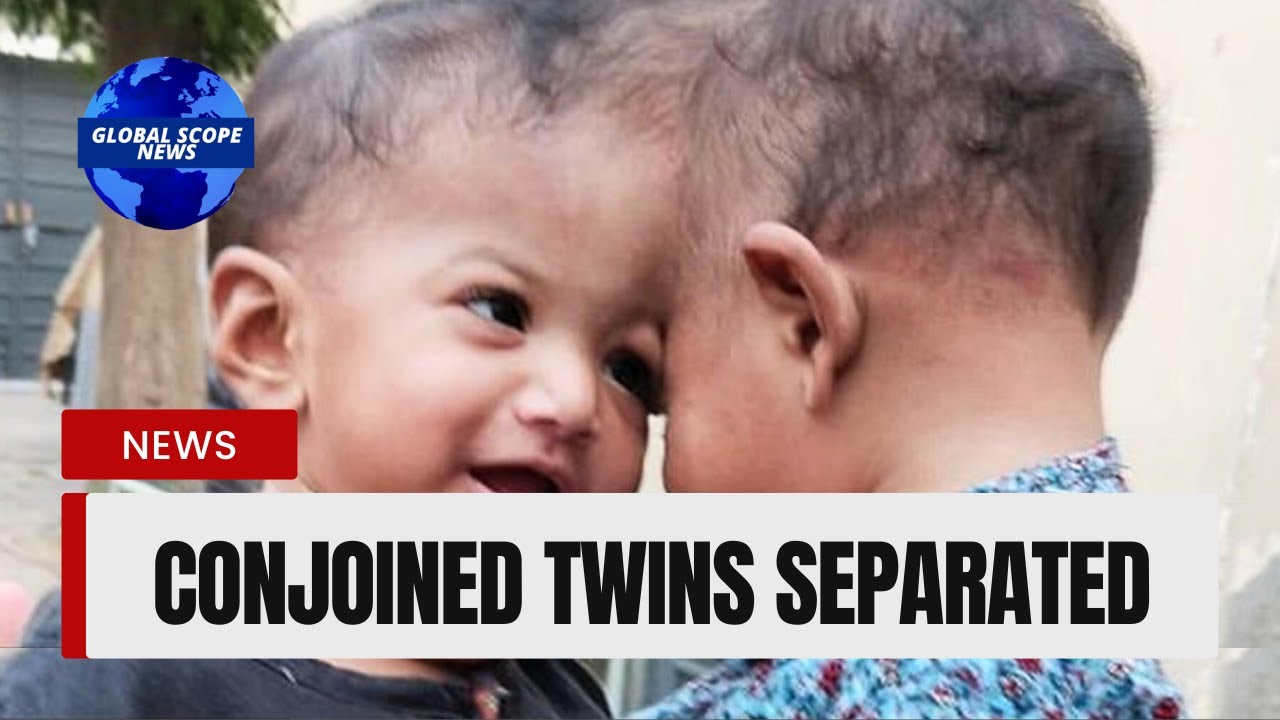Conjoined Twins Separated by British and Turkish Surgeons
