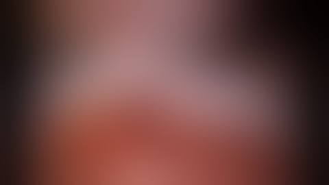 TAPP TIPS   Placing ProGrip Mesh in Robotic TAPP Inguinal Hernia Repair