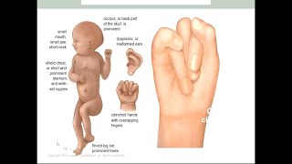 Abnormality of chromosome 2 التغاير الكروموسومي د. محمد الزيادي