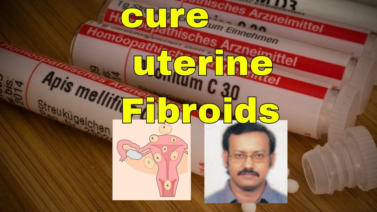 Uterine Fibroids /uterine fibriod causes /Symptoms /how to shrink uterine fibroid in homeopathy