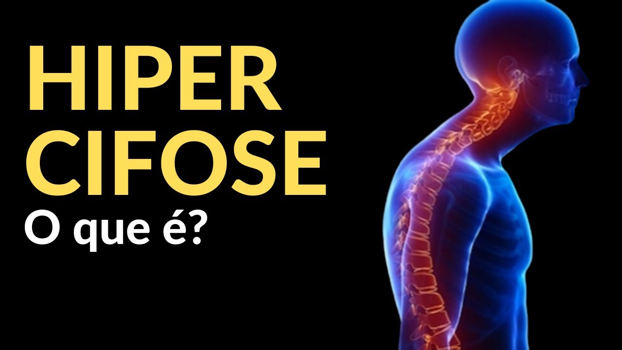 o-que-hipercifose-youtube