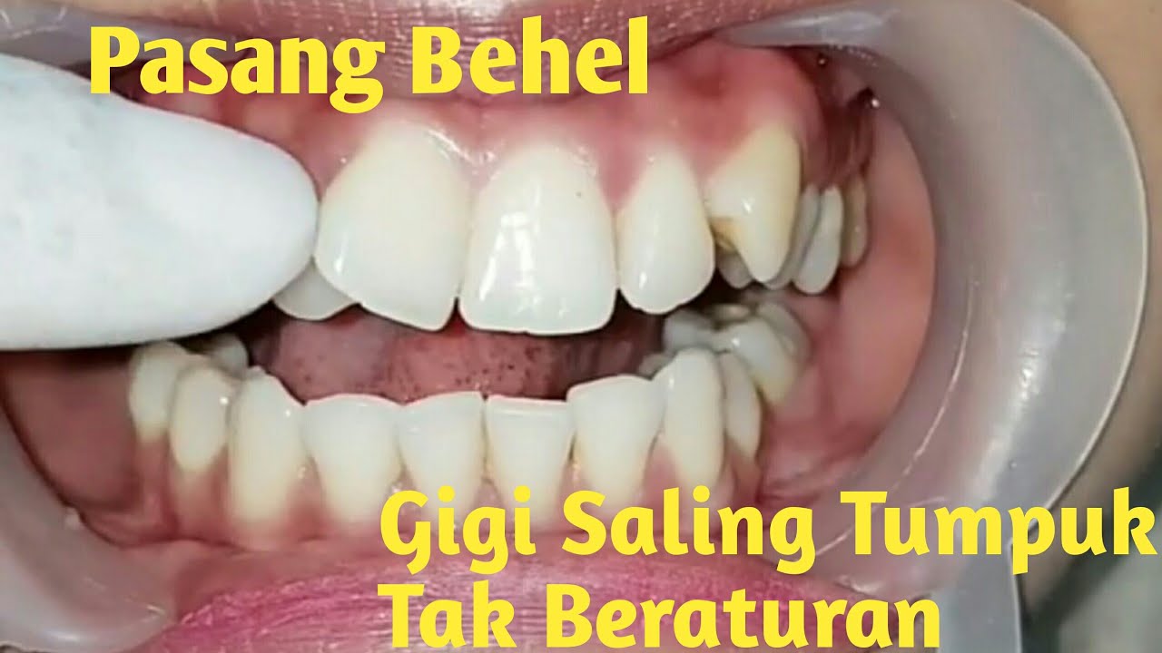 Macam Cara Meratakan dan Merapikan Gigi tanpa Pasang kawat dan Behel