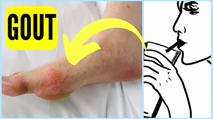 Biggest Reason People Get Gout - DayDayNews