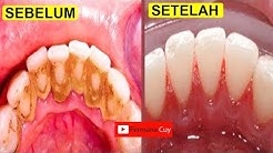 Cara Menghilangkan Karang Gigi Dalam 5 Menit Tanpa Harus Ke Dokter Gigi - Durasi: 3.59. 