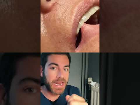 Vidéo: Pourquoi ma lèvre pleure ?