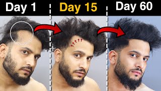 TRAYA REVIEW: FIX Your Receding Hairline with THIS | Before You Try, Watch This Video!