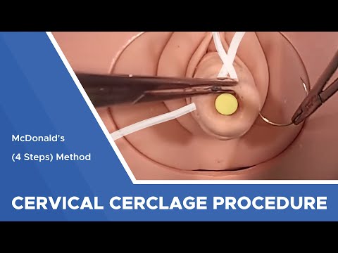 Cervical Cerclage using with 5 mm Mersilene Tape: McDonald (4 Steps) Method