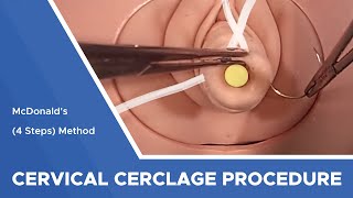 Cervical Cerclage using with 5 mm Mersilene Tape: McDonald (4 Steps) Method