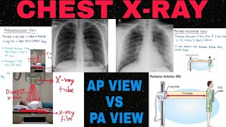 Chest Xray : PA vs AP view