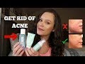 SECRET TO CLEARING UP MY ACNE! HOW TO GET RID OF ACNE FAST!