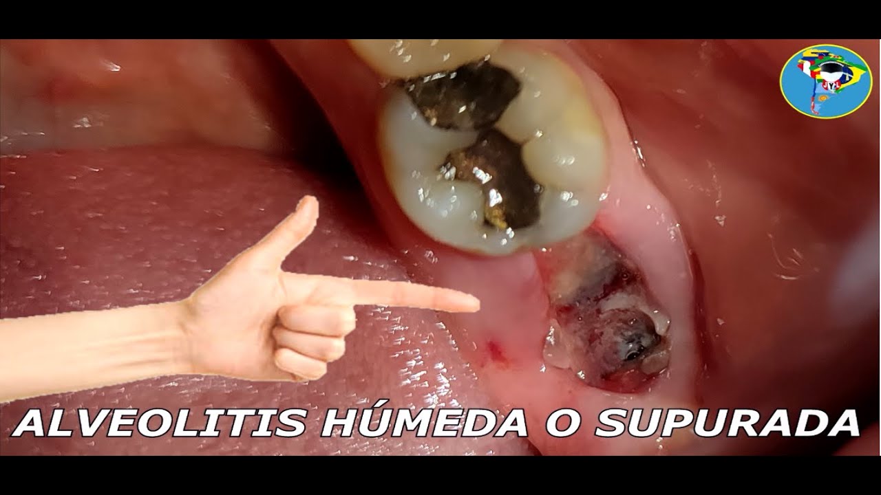 Tratamiento Para Alveolitis Humeda Y Alveolitis Seca Youtube 