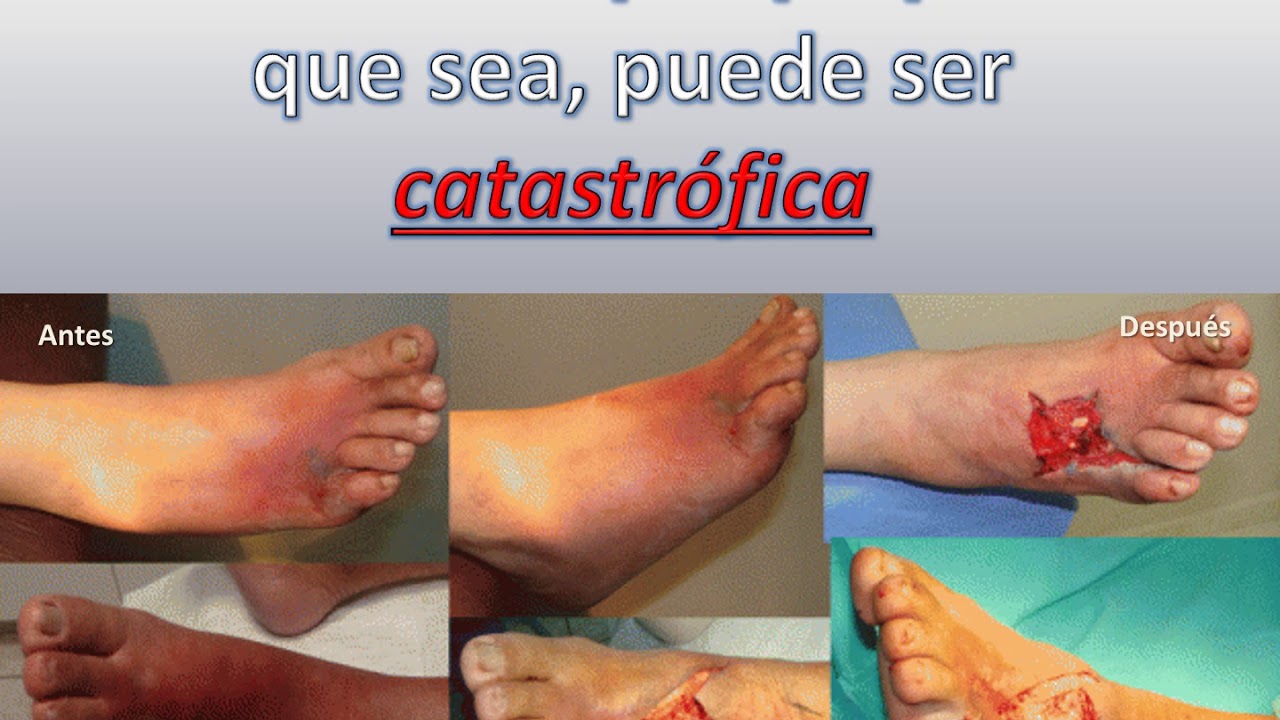 Monstruo llamado Diabetes. Oswaldo Silva camera iphone 8 plus apk