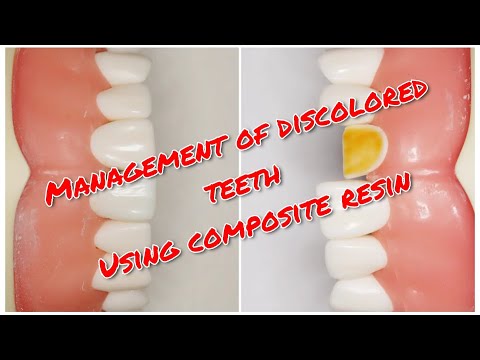 Management of discolored anterior teeth using composite resin