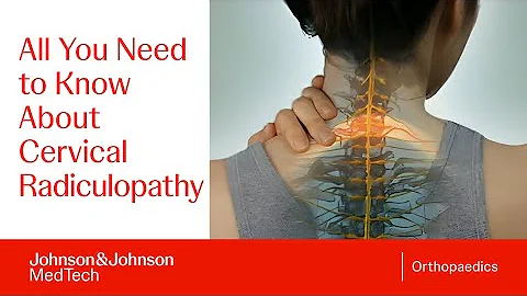 Cervical Radiculopathy - DePuy Videos