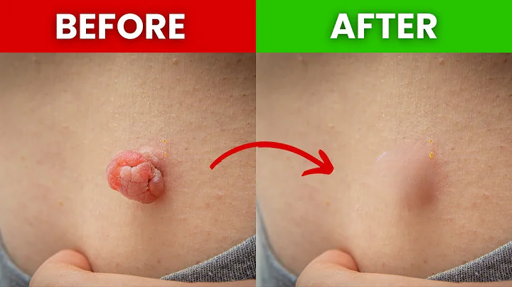 Say Goodbye to Skin Tags & Warts Forever: The Ultimate Remedy
