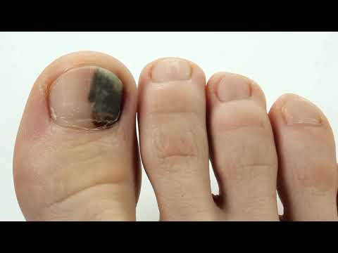 Почему чернеют ногти на больших пальцах ног у женщин, у мужчин причины