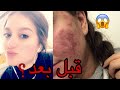 كيف عالجت بشرتي نهائيا (صور قبل وبعد) طريقة للتخلص من حب الشباب