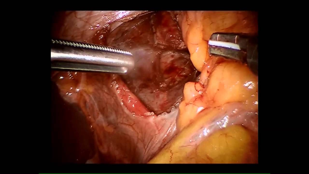 Paraesophageal hernia and creation of small pouch bariatric fusion