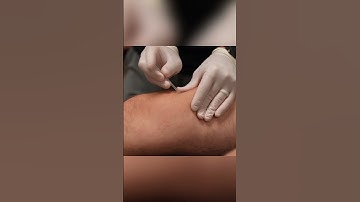 Dry Needling Tight Quads