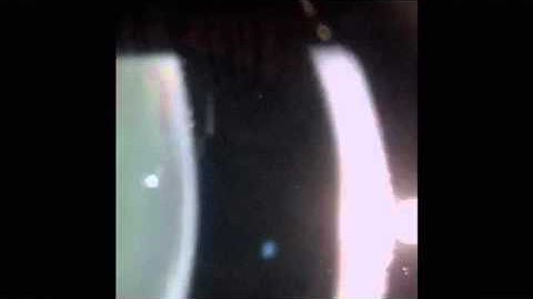 Jaiz ARIS: Convection current in anterior chamber of the Eye