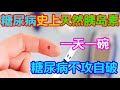 糖尿病史上的天然胰島素！壹天壹碗，糖尿病不攻自破【侃侃養生】