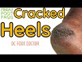 Friday Foot FAQs: Cracked Heels