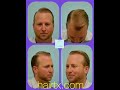 ARTAS FUE Hair Transplant Video Multiple Angle Transformation