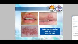 شرح العدوات البكتيرية التى تصيب الجلد - البورد الأمريكى للصيادلة screenshot 5