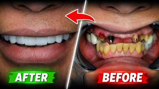 I TRANSFORMED My Patient's Broken Smile With an INSANE Amount of Dental Work (Before & After) 😁