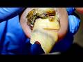 This Toenail Is Seriously Sick, Trim It Little By Little【Xue Yidao】