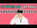 3types of lifting method for sagging eyelid / blepharoplasty, subbrow, forehead lifting / Anti-aging
