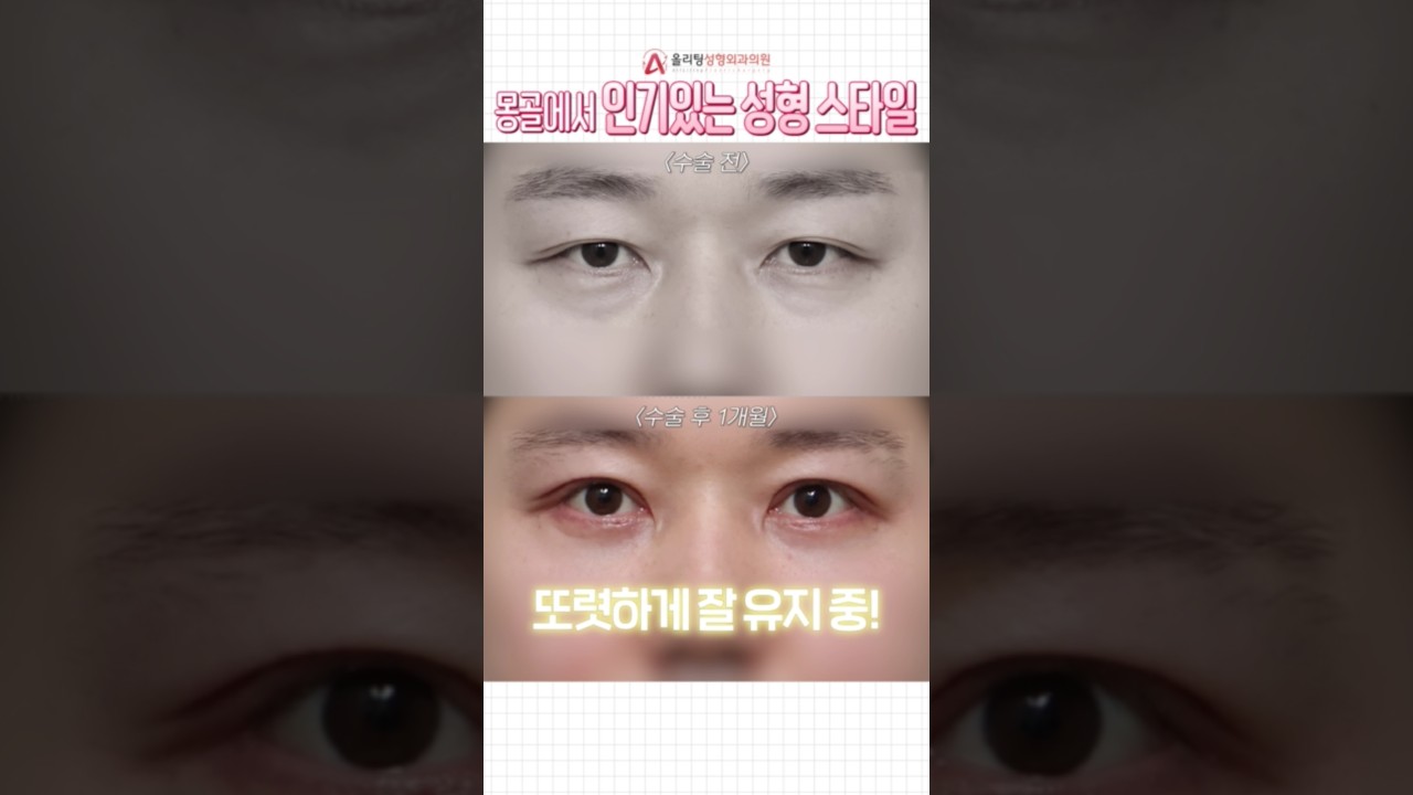 [Олитинг гоо сайхны мэс заслын эмнэлэг] Тодорхой өөрчлөлт хүсэж буй монголчуудын хийлгэдэг гоо сайхны мэс засал юу вэ? #ГооСайхныЗөвлөгөө #Шортс #Сэдэв