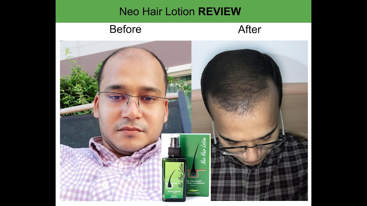 Before & After I 100 original Neo Hair Lotion 3 Pcs Best Hair loss Solution No side effect