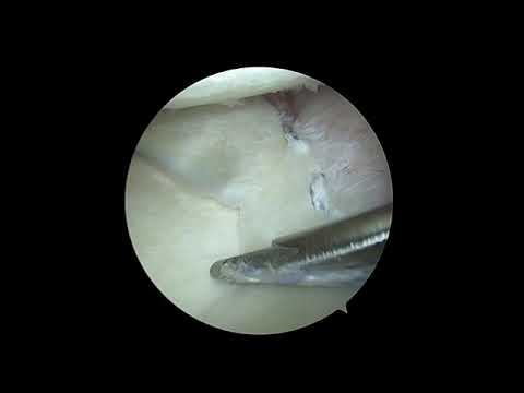 Arthroscopic Centralization of the Extruded Medial Meniscus